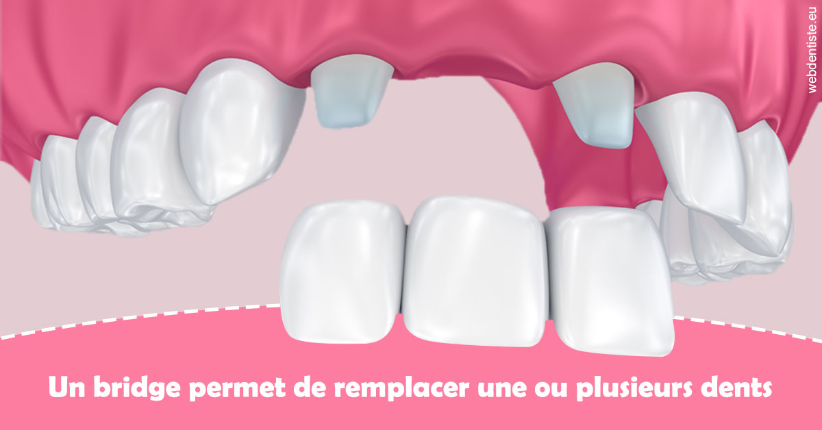 https://dr-taverniers-jeroen.chirurgiens-dentistes.fr/Bridge remplacer dents 2