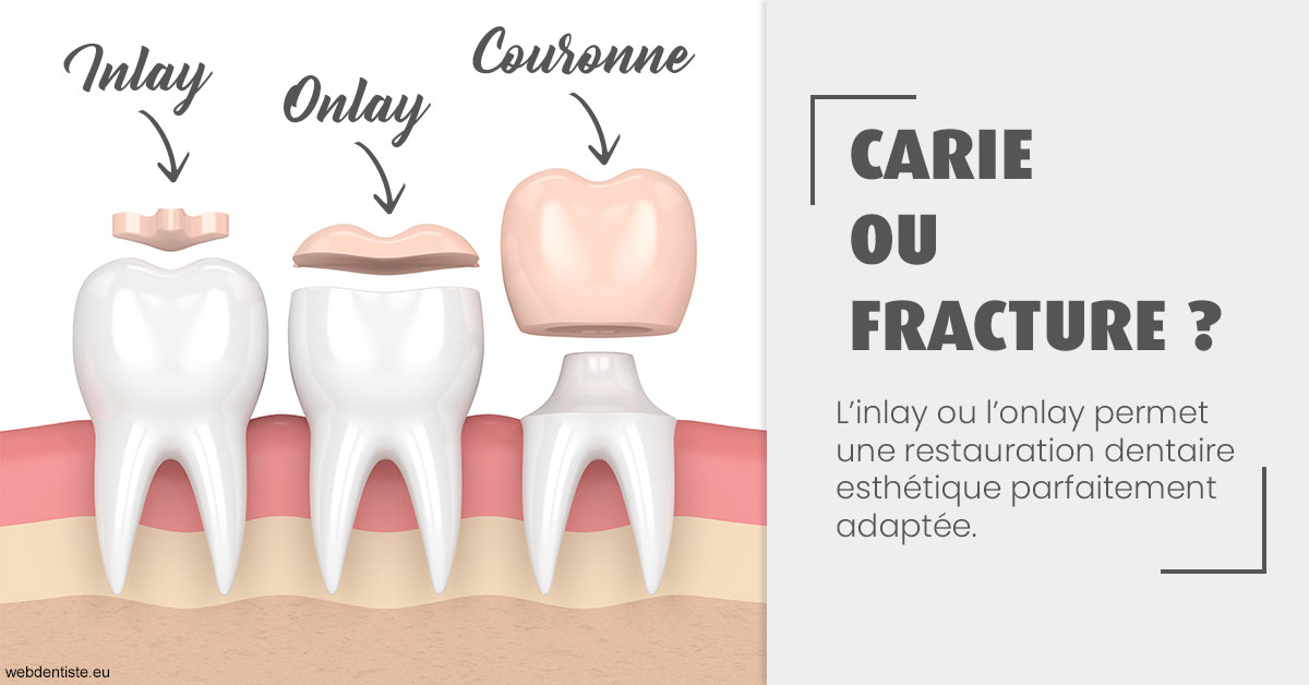 https://dr-taverniers-jeroen.chirurgiens-dentistes.fr/T2 2023 - Carie ou fracture 1