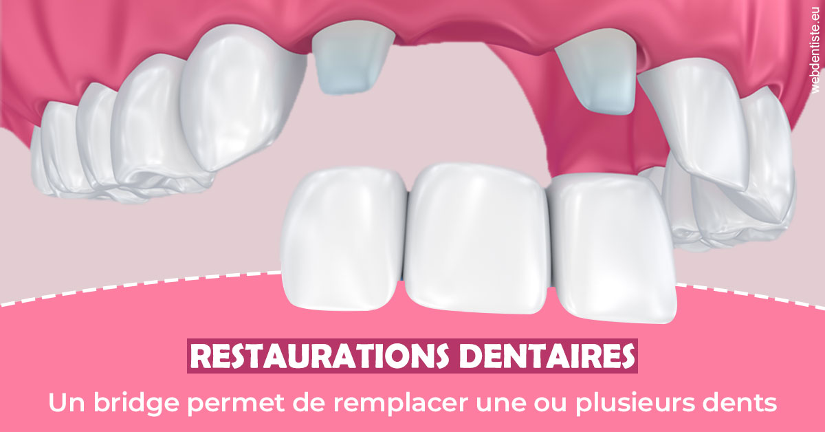 https://dr-taverniers-jeroen.chirurgiens-dentistes.fr/Bridge remplacer dents 2