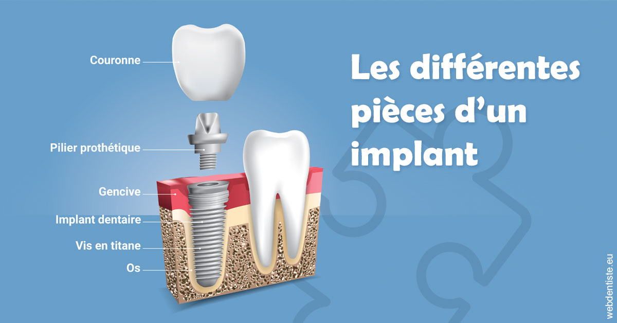 https://dr-taverniers-jeroen.chirurgiens-dentistes.fr/Les différentes pièces d’un implant 1